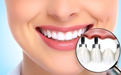Dental Implants in Redlands Restore Your Smile with Tulip Dental