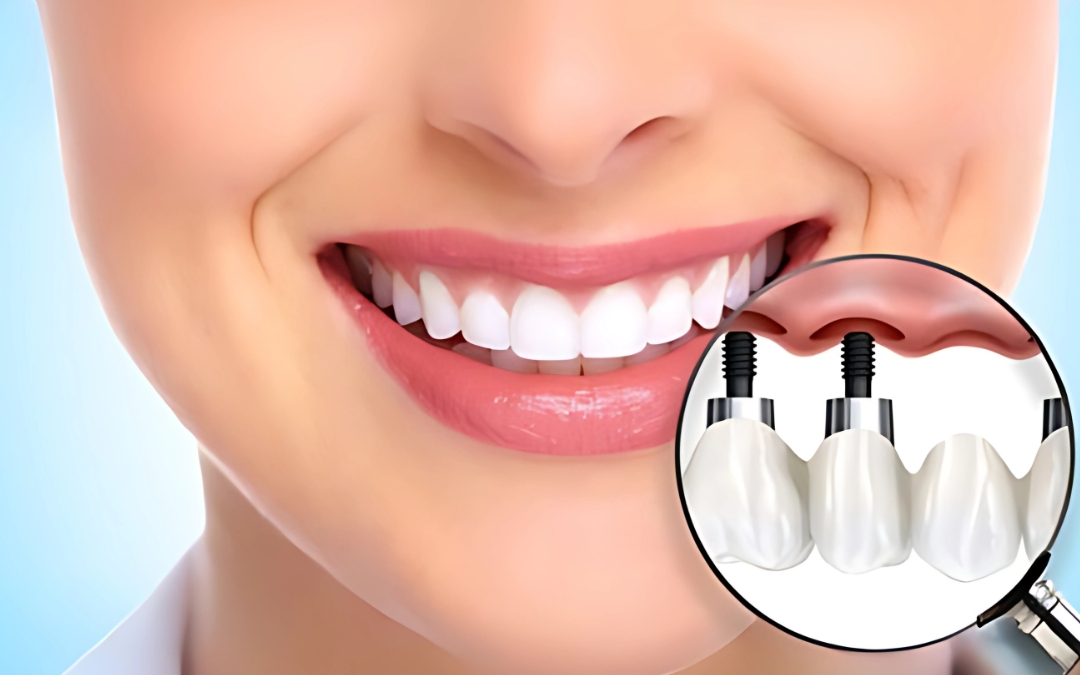Dental implants near me treatment in redlands by tulip dental