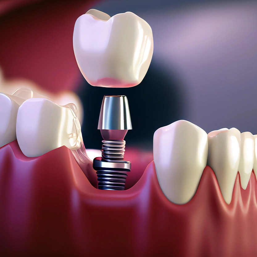 dental implants