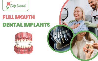 A Complete Guide to the Full Mouth Dental Implants at Tulip Dental
