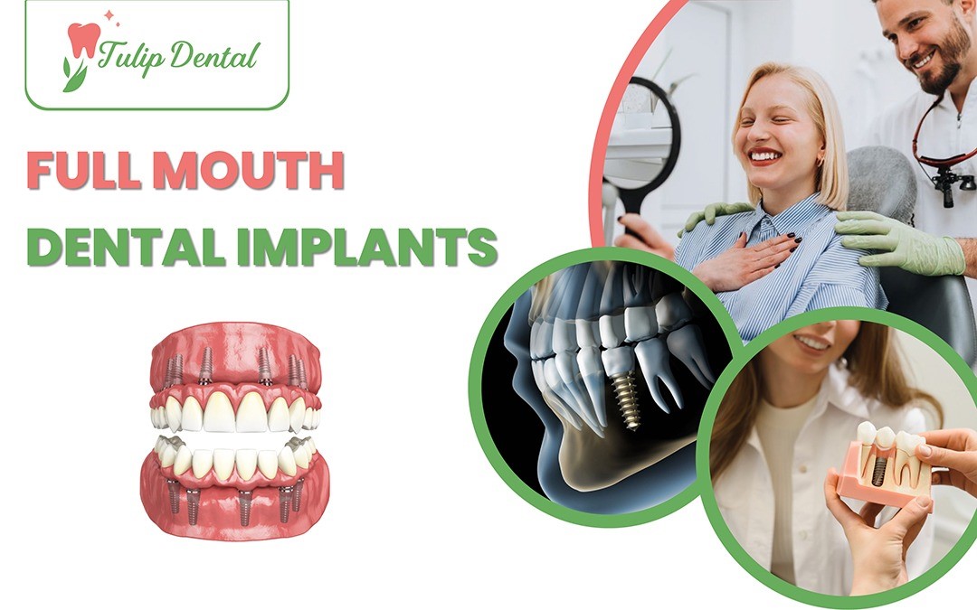 Full mouth dental implants in redlands by tulip dental