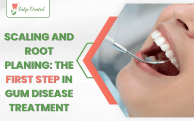 Scaling and Root Planing: The First Step in Gum Disease Treatment