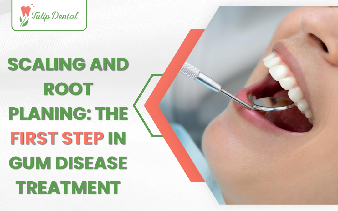 Scaling and root planing deep cleaning treatment for gum disease in USA dental clinic