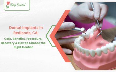 Dental Implants in Redlands, CA: Cost, Benefits, Procedure, Recovery & How to Choose the Right Dentist