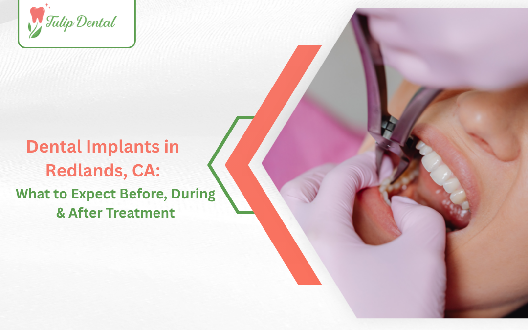 Dental Implants in Redlands, CA: What to Expect Before, During & After Treatment