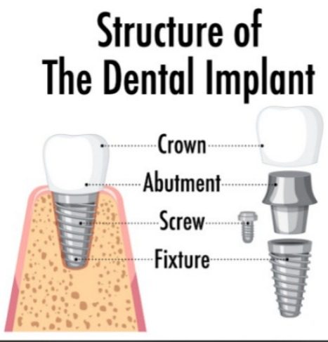 Dental Implants<br />
